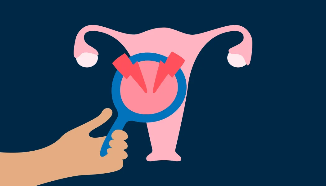 Endometriosis: what are the different forms of the disease?
